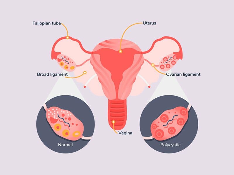 pcos supplements