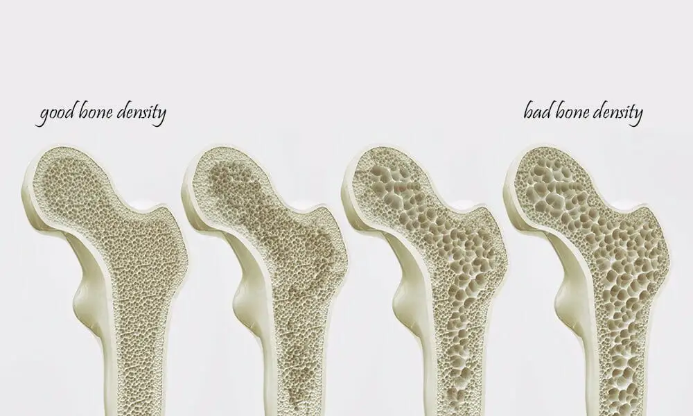 bone density