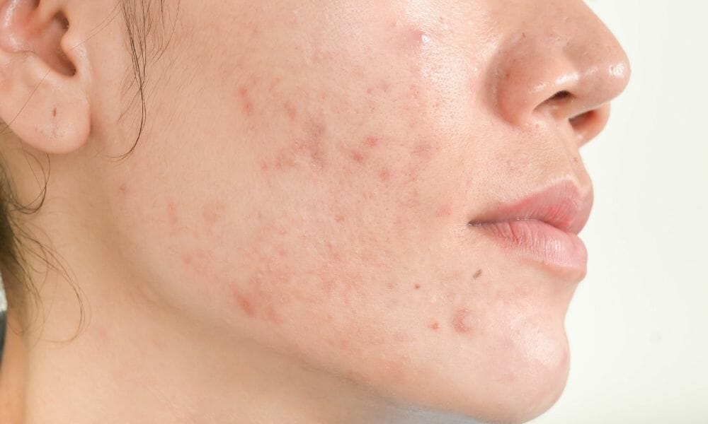 Cream Of Tartar Health Benefits For Acne