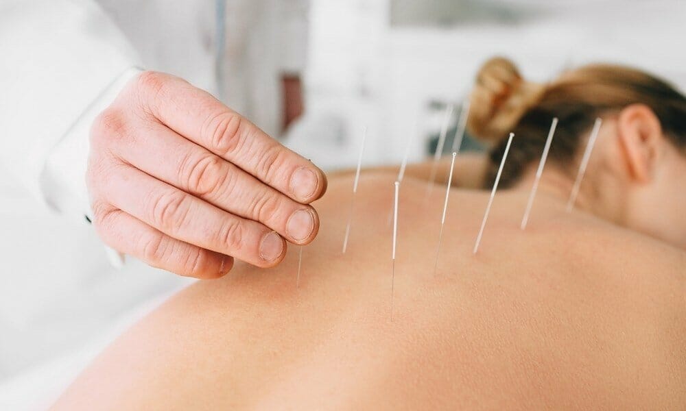 Natural Remedies Acupuncture