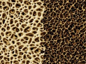 bone density picture