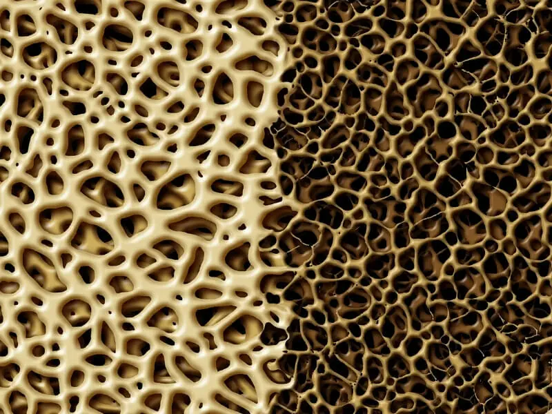 bone density picture